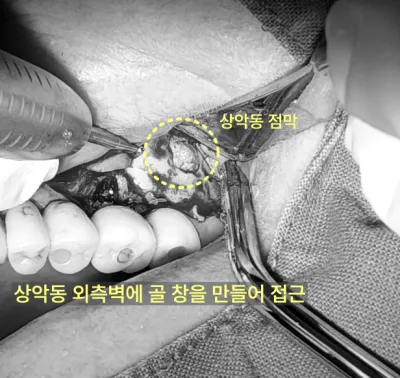 상악동 외측벽에 골 창을 만들어 접근한 수술 사진.