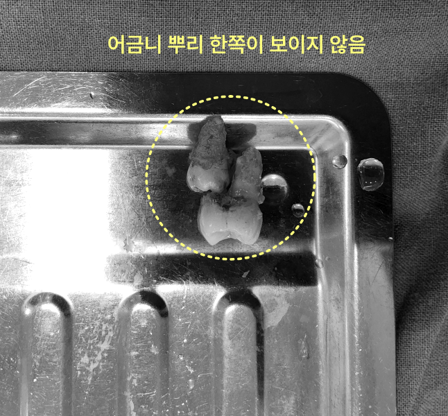 어금니 뿌리 한쪽이 보이지 않는 발치된 치아 사진