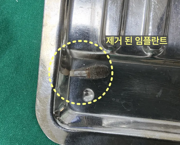 제거된 임플란트 픽스처가 놓인 수술 도구 트레이