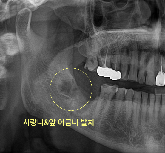 사랑니와 앞 어금니가 발치된 엑스레이 사진.