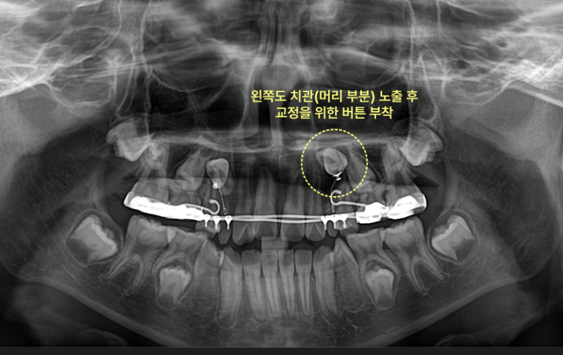 아이 송곳니가 안 나옵니다, 기다려도 될까요? 7 왼쪽 송곳니 노출 후 교정 버튼 부착 X-ray