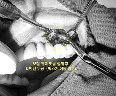 보철 위쪽 잇몸 절개 후 확인된 누공을 보여주는 수술 사진.