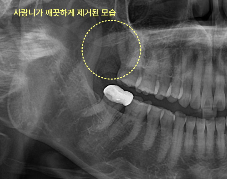 엑스레이 사진에 사랑니가 제거된 빈 공간이 노랗게 표시되어 있다.