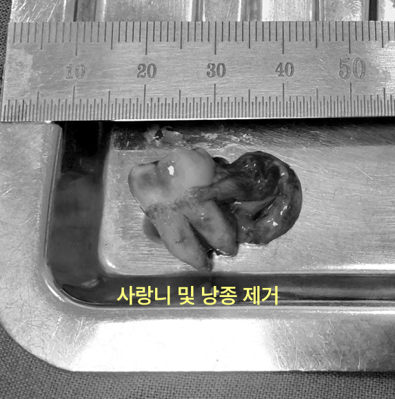 제거된 사랑니와 낭종이 수술 도구 위에 놓여 있다.