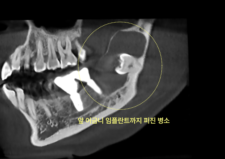 사랑니를 방치하면 앞 어금니까지 뽑아야 하나요? 5 사랑니 병소가 앞 어금니 임플란트까지 퍼진 CT 사진