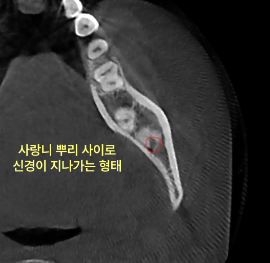 사랑니 뿌리가 신경과 가까우면 발치를 어떻게 하나요? 6 사랑니 뿌리 사이로 신경이 지나가는 CT 사진