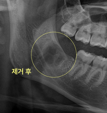사랑니와 낭종 제거 후 엑스레이
