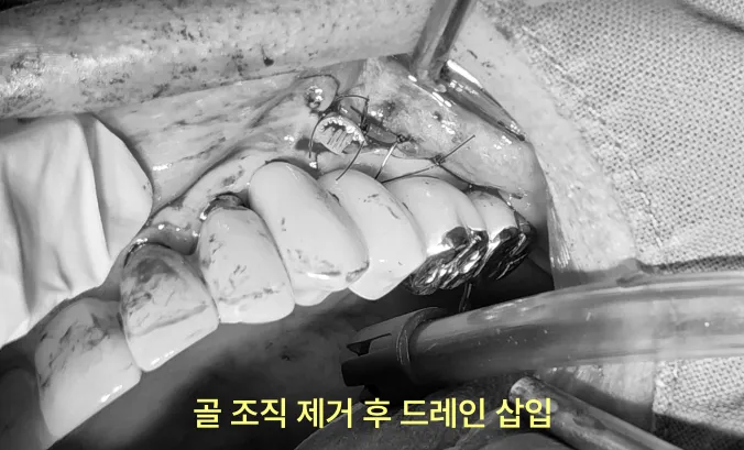 인천임플란트 실패하면 이렇게 돼요-사진 有