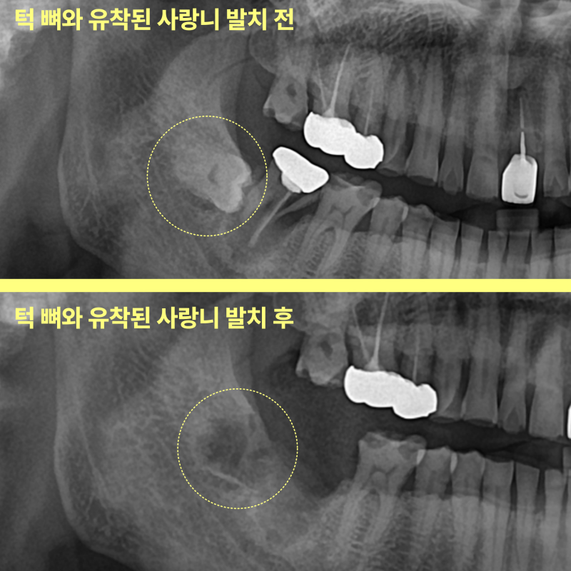사랑니 발치, 미루면 더 힘들어지는 이유