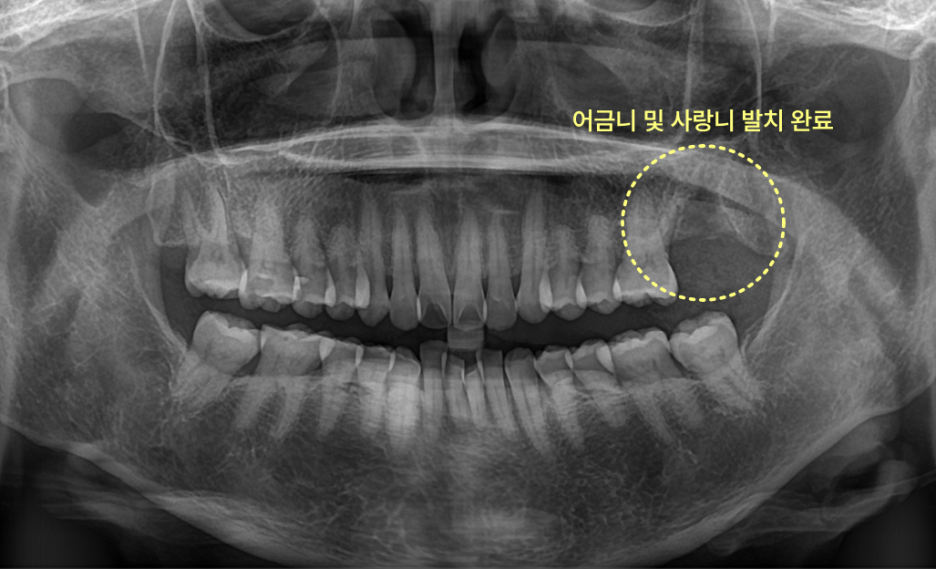 어금니와 사랑니 발치 후의 엑스레이 사진으로, 발치된 부위가 노란색 원으로 표시되어 있다.