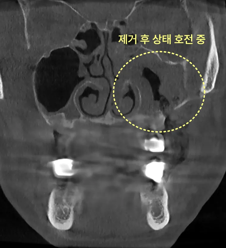 구월동치과 축농증이 안 낫는다면 이것 때문일 수 있어요