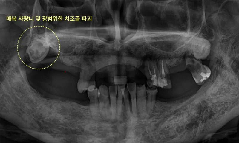 매복 사랑니와 광범위한 치조골 파괴를 보여주는 엑스레이 사진.