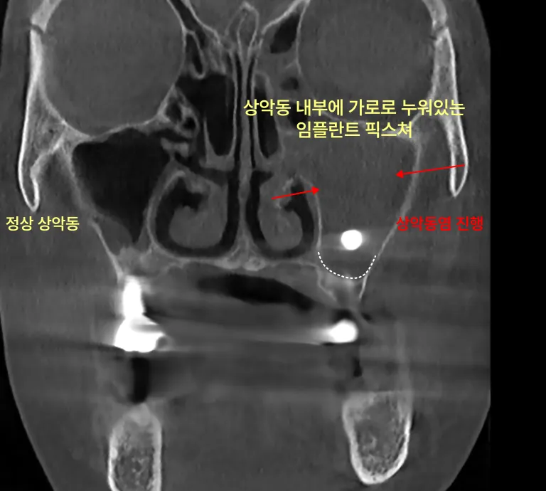 상악동 내부에 가로로 누워있는 임플란트 픽스처를 보여주는 CT 사진.
