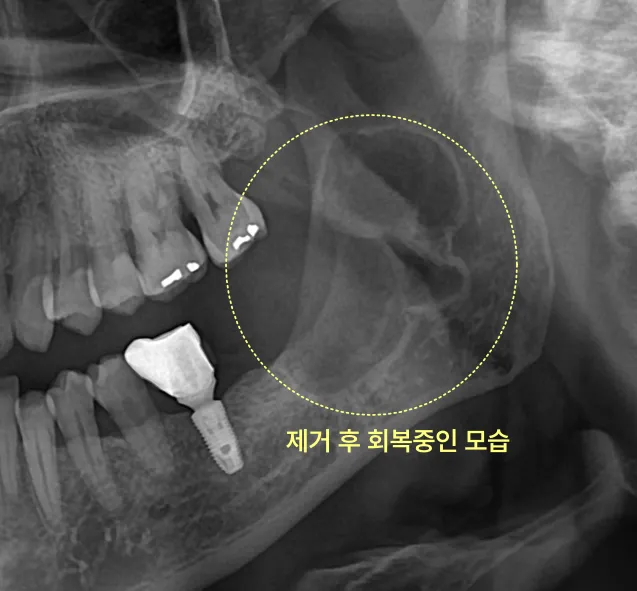 사랑니를 방치하면 앞 어금니까지 뽑아야 하나요? 8 사랑니와 병소 제거 후 회복 중인 엑스레이 사진