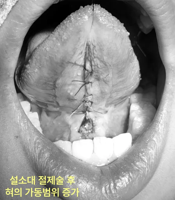 아이 영어 발음 때문에 설소대 절제술을 고민한다면 9 설소대 절제술 후 혀의 가동 범위가 증가한 모습