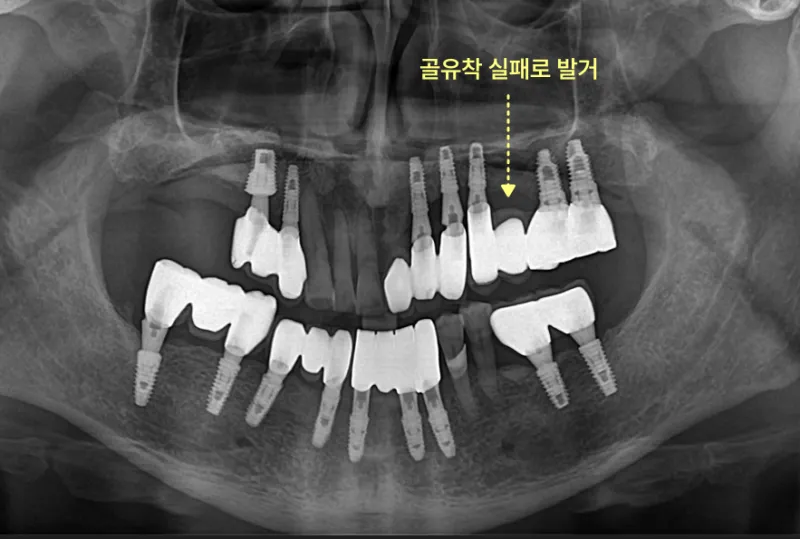 임플란트가 식립된 치아 엑스레이 사진. 골유착 실패로 발거된 임플란트가 표시되어 있다.