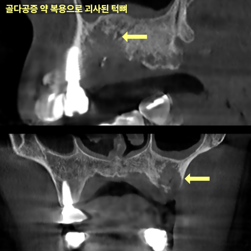 골다공증 약 복용으로 괴사된 턱뼈를 보여주는 CT 사진 두 장