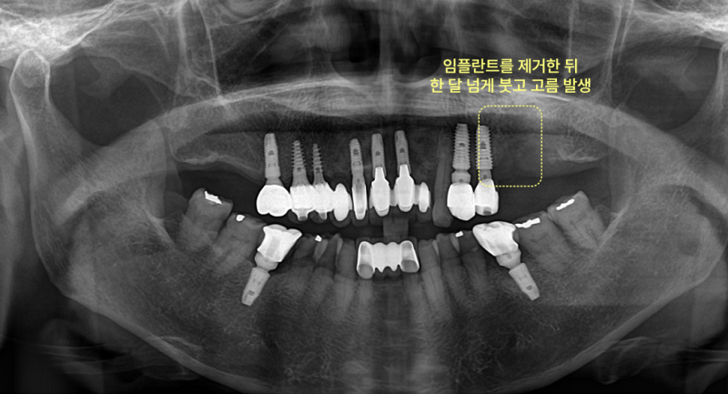 임플란트 제거 후 턱뼈 괴사 및 고름 발생을 보여주는 파노라마 방사선 사진