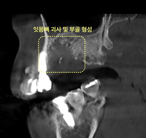 상악동 부위 잇몸뼈 괴사 및 부골 형성을 보여주는 CT 사진