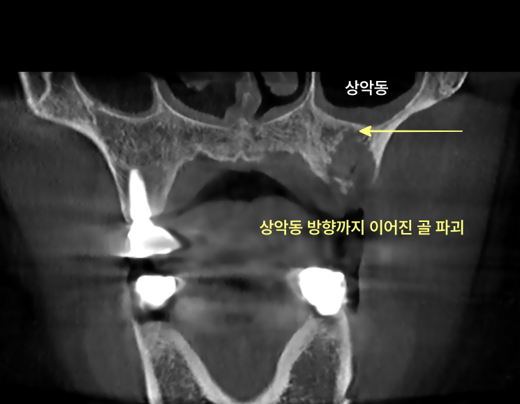 상악동 방향까지 이어진 골 파괴를 보여주는 CT 사진