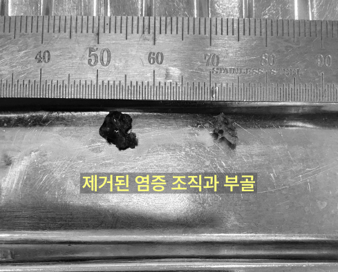 제거된 염증 조직과 부골을 보여주는 임상 사진