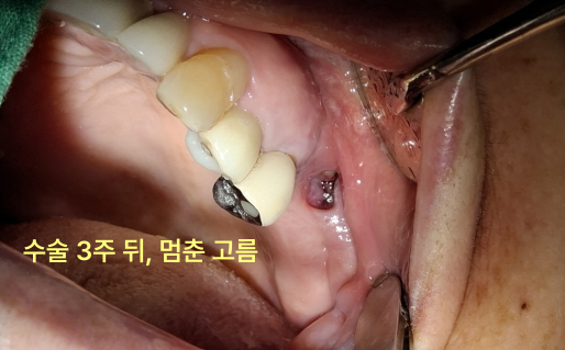 수술 3주 후 고름이 멈춘 하악 좌측 어금니 부위 구강 내 사진