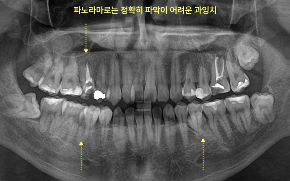 파노라마 엑스레이로 본 과잉치