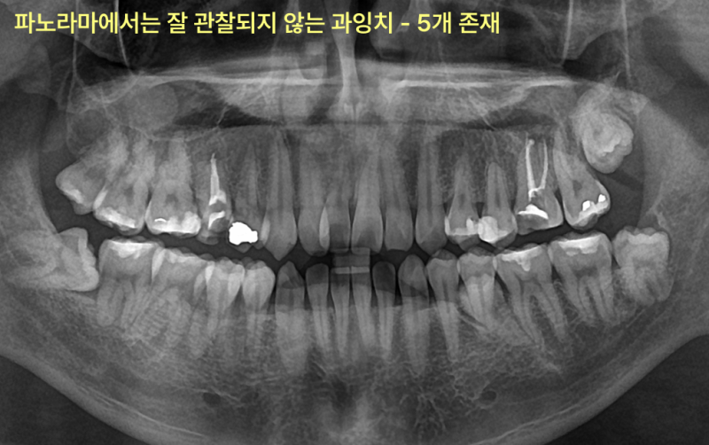 가정동치과 신경치료 병원 추천 기준 6 가정동치과 신경치료 병원 추천 기준 관련 사진 4