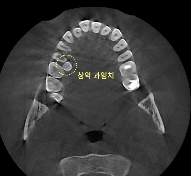 CT 촬영으로 본 상악 과잉치