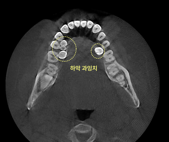 CT 촬영으로 본 하악 과잉치