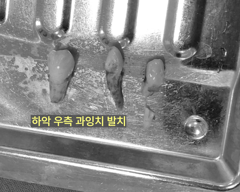 발치된 하악 우측 과잉치들