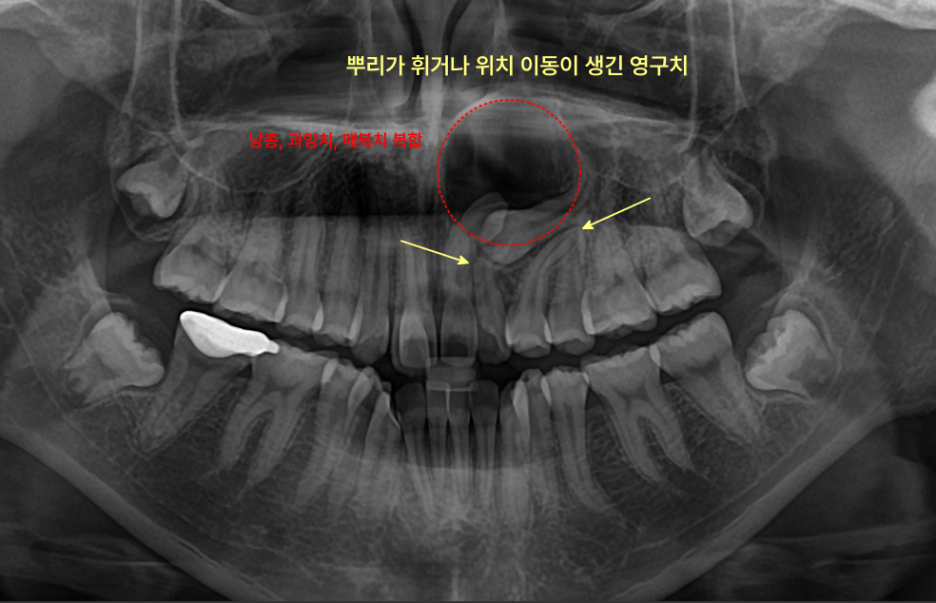 상악 전치부 매복 영구치와 낭종이 보이는 파노라마 방사선 사진