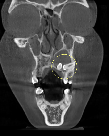 상악 전치부 매복 영구치와 낭종이 보이는 CT coronal view 사진