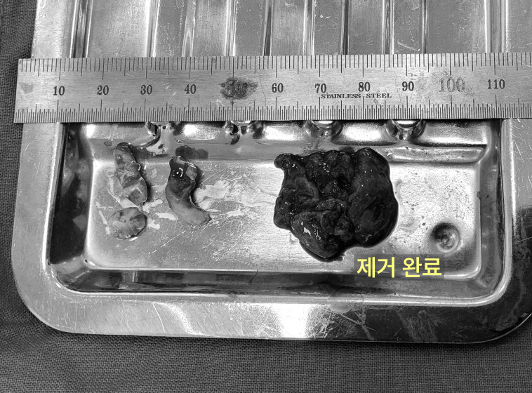 스테인리스 트레이 위에 제거된 낭종 조직과 치아 조각들이 놓여 있는 사진