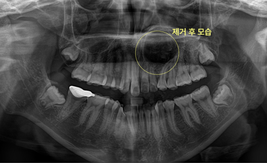 낭종 및 매복치 제거 후 상악 전치부 파노라마 방사선 사진