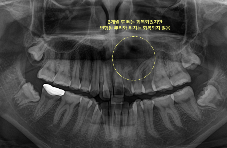 낭종 및 매복치 제거 6개월 후 상악 전치부 파노라마 방사선 사진