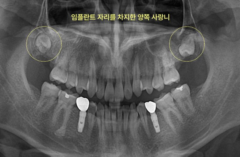 구월동치과 임플란트 앞 사랑니 꼭 빼야 할까요 4 파노라마 방사선 사진으로 본 상악 양쪽 사랑니와 하악 임플란트