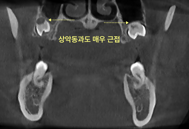 구월동치과 임플란트 앞 사랑니 꼭 빼야 할까요 6 CT 사진에서 상악동과 근접한 양쪽 사랑니