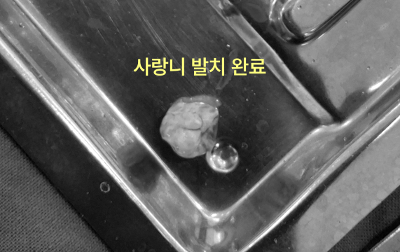 구월동치과 임플란트 앞 사랑니 꼭 빼야 할까요 7 발치된 사랑니가 놓인 의료용 트레이 클로즈업