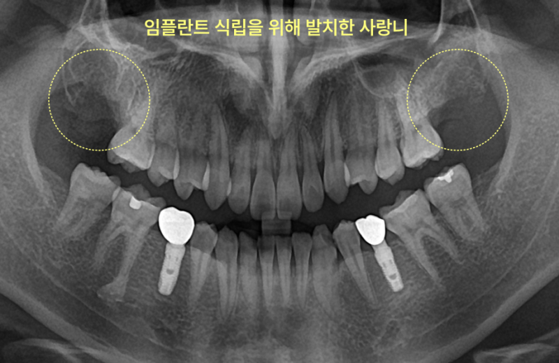 구월동치과 임플란트 앞 사랑니 꼭 빼야 할까요 8 사랑니 발치 후 상악 양쪽 사랑니 부위가 비어있는 파노라마 방사선 사진