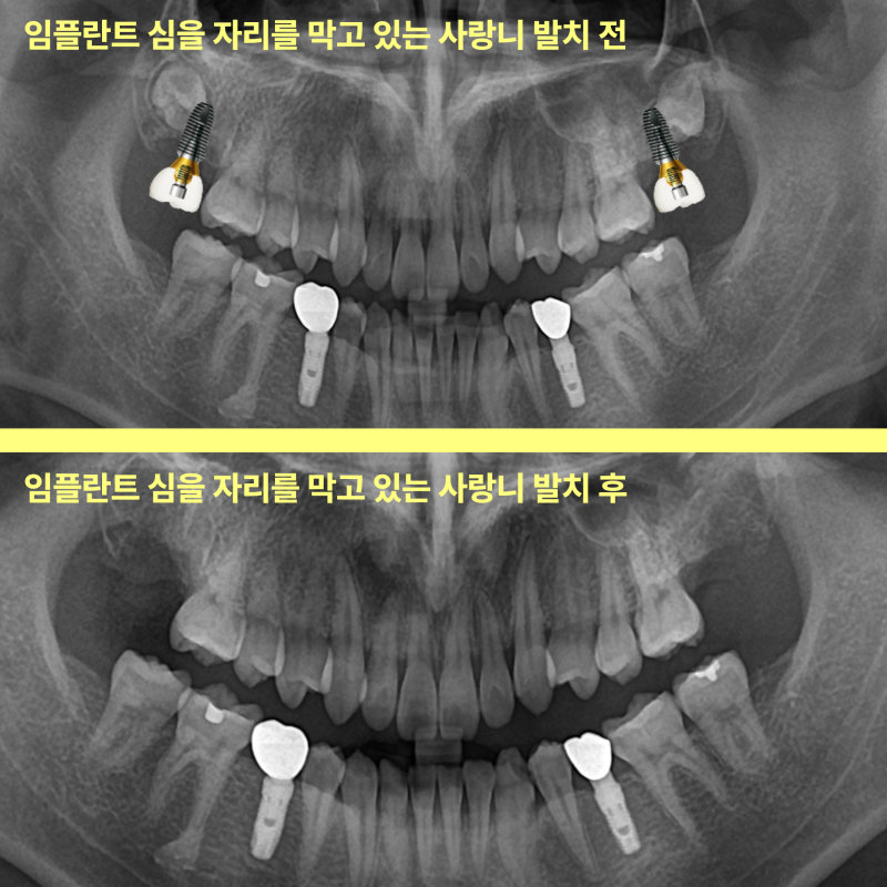 구월동치과 임플란트 앞 사랑니 꼭 빼야 할까요 10 사랑니 발치 전후 임플란트 식립 위치를 비교하는 파노라마 방사선 사진