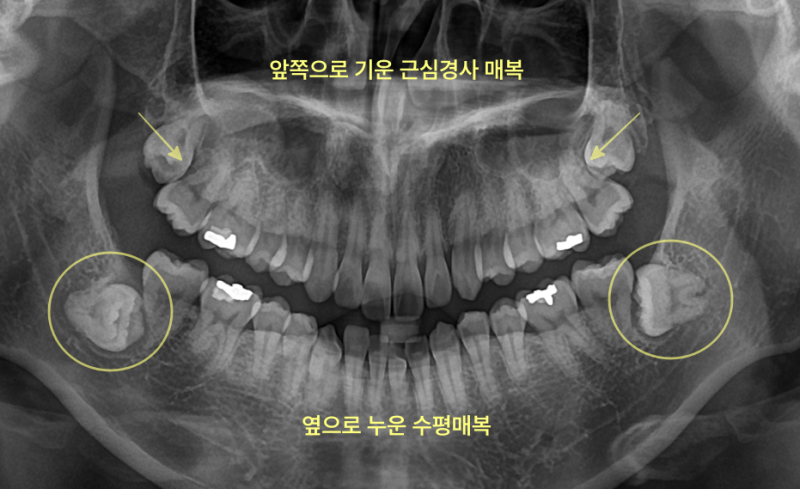 사랑니 매복 상태를 보여주는 파노라마 방사선 사진