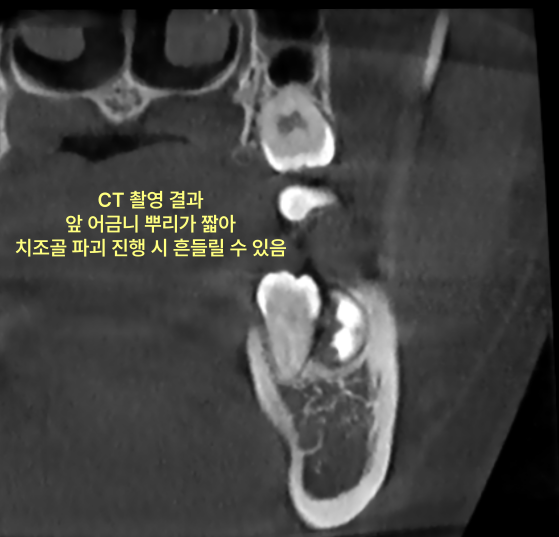 하악 사랑니와 인접 어금니 뿌리 관계를 보여주는 CT 촬영 결과