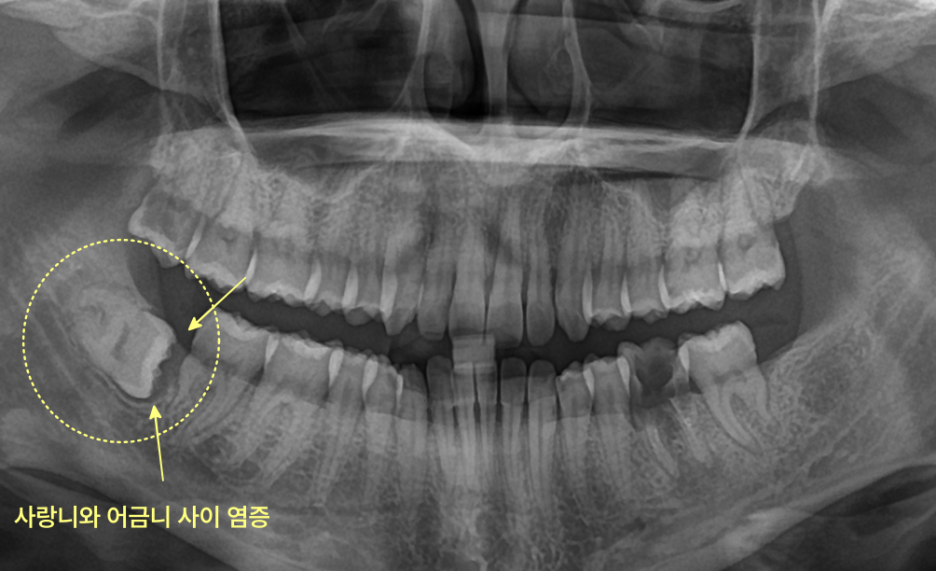 사랑니와 어금니 사이에 염증이 있는 하악 파노라마 방사선 사진