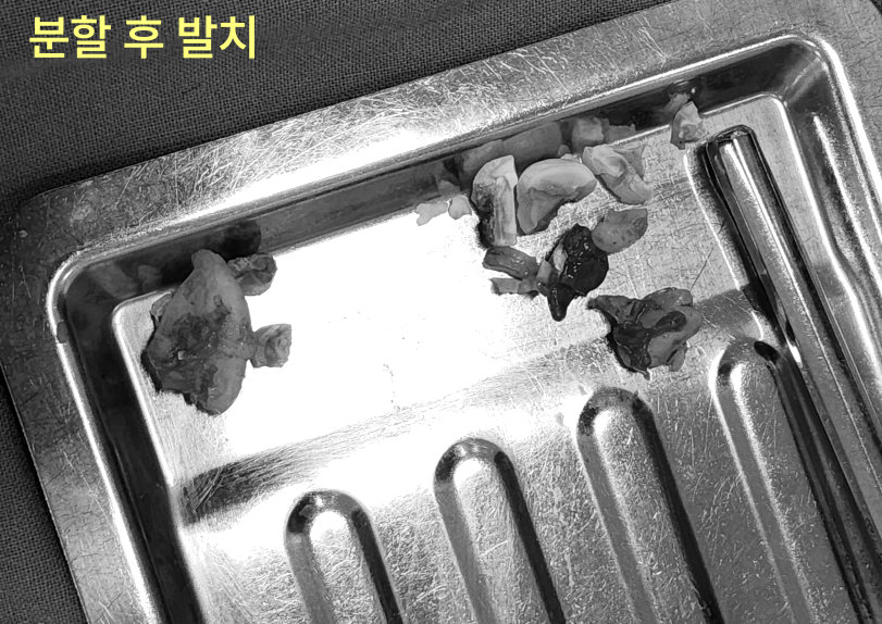 분할 발치된 사랑니 조각들이 담긴 멸균 트레이
