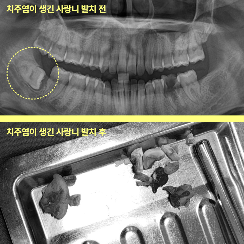 치주염이 생긴 사랑니 발치 전후를 비교하는 파노라마 방사선 사진과 발치된 사랑니 사진