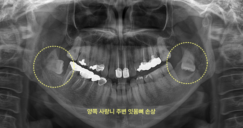 사랑니 주변 잇몸뼈가 손상된 엑스레이 사진