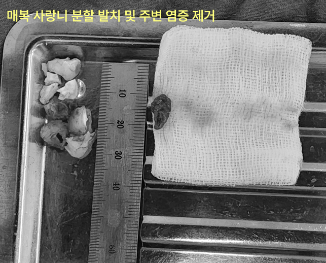 매복 사랑니 발치 후 제거된 염증과 치아 조각