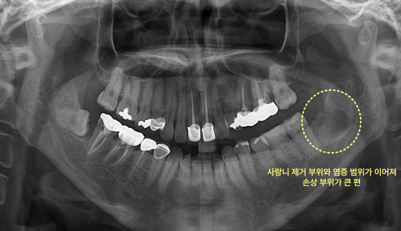 사랑니 제거 후 염증 범위가 큰 엑스레이 사진