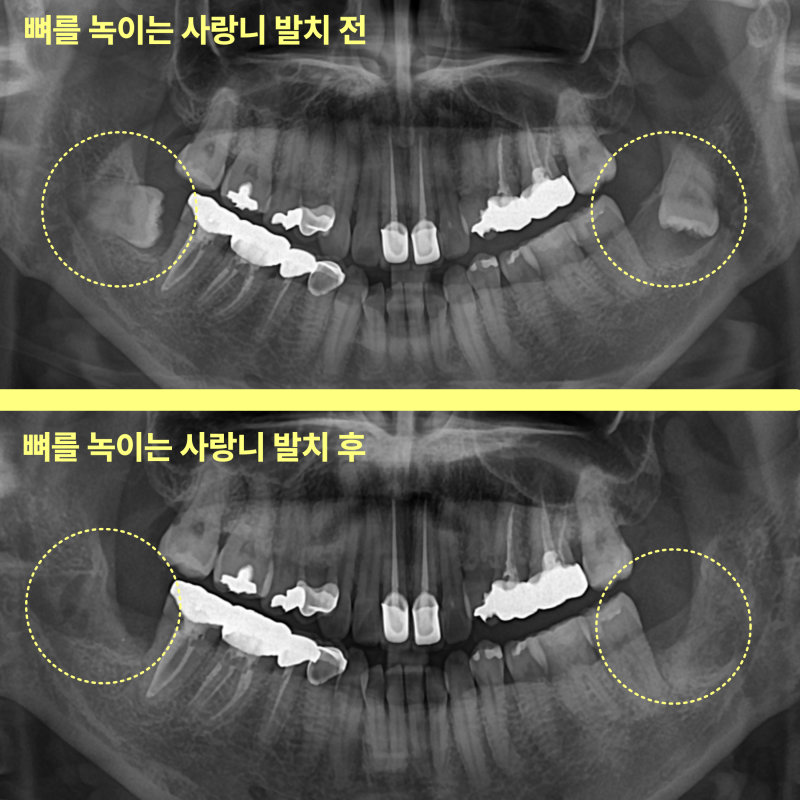 사랑니 발치 전후 잇몸뼈 회복 비교 엑스레이